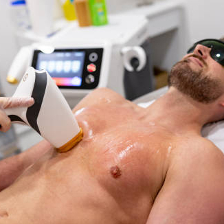 Laser Hair Removal